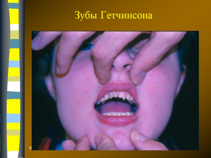 09.12.2017  Зубы Гетчинсона